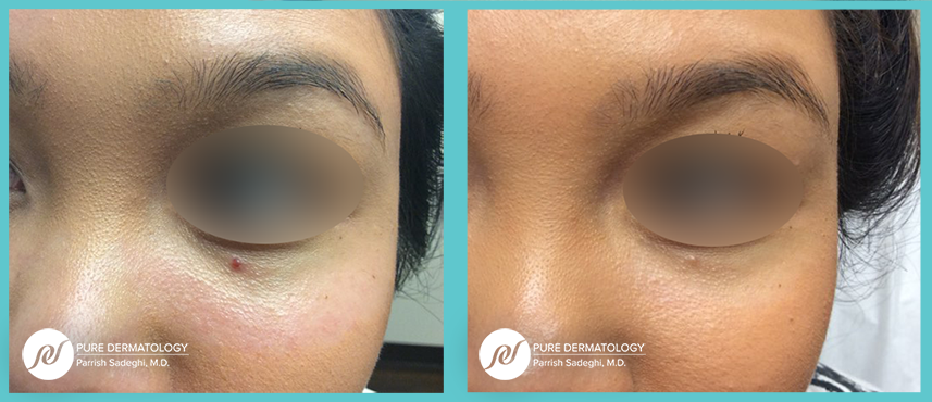 patient before and after treatment for Angiomas at Pure Dermatology