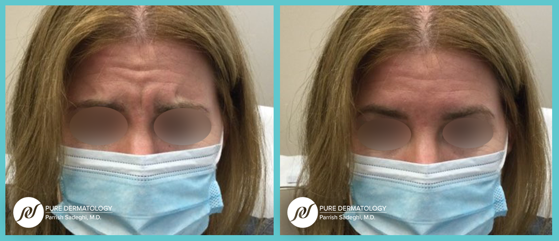 A before and after photo of a woman wearing a mask.