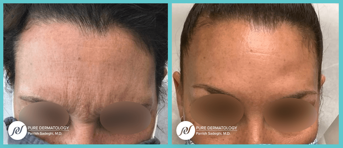 patient before and after Botox injections at Pure Dermatology