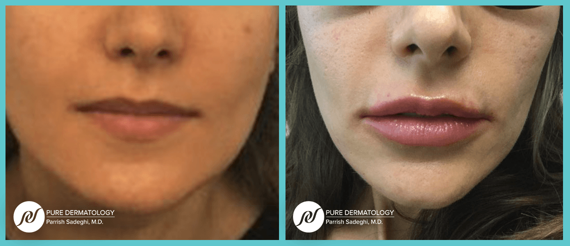 before and after fillers from pure dermatology