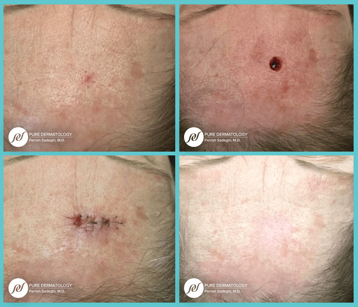 patient before and after Mohs Micrographic Surgery at Pure Dermatology