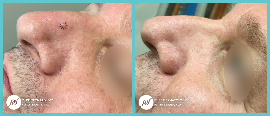 patient before and after mole removal treatment at Pure Dermatology
