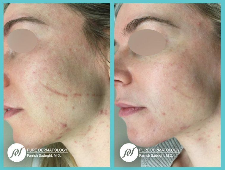 A before and after photo of a woman 's face with acne.