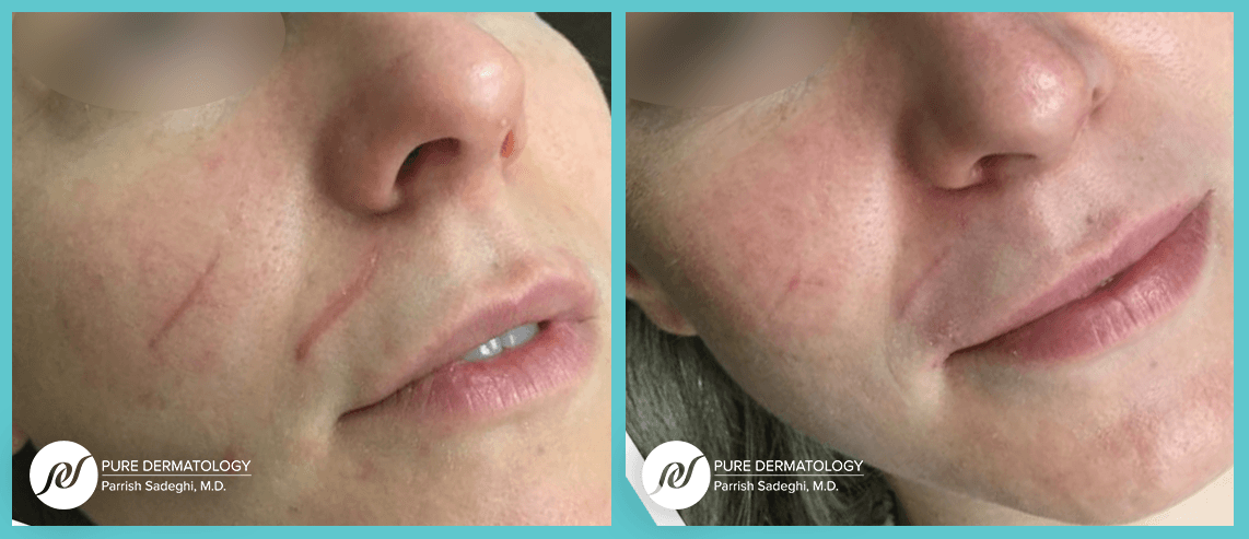 patient before and after Scar Improvement treatment at Pure Dermatology