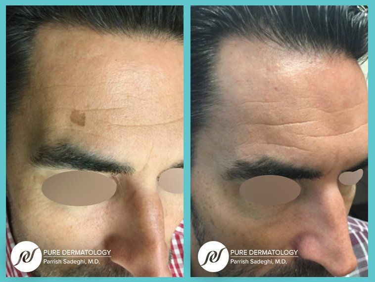 A before and after photo of a man 's forehead with a wart on it.