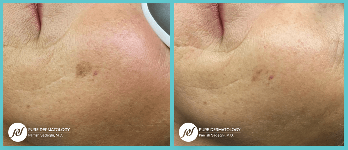 patient before and after Age Spot/Sun Spot treatment at Pure Dermatology