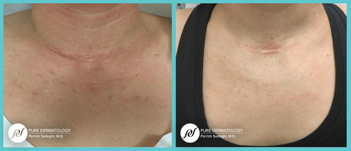 A before and after photo of a woman 's neck and chest