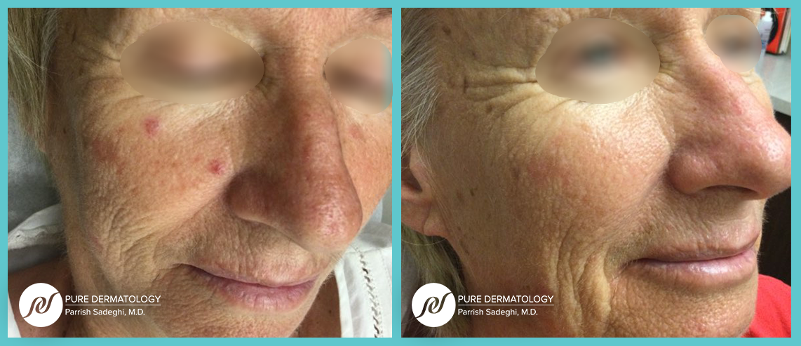 patient before and after treatment for Broken Capillaries at Pure Dermatology