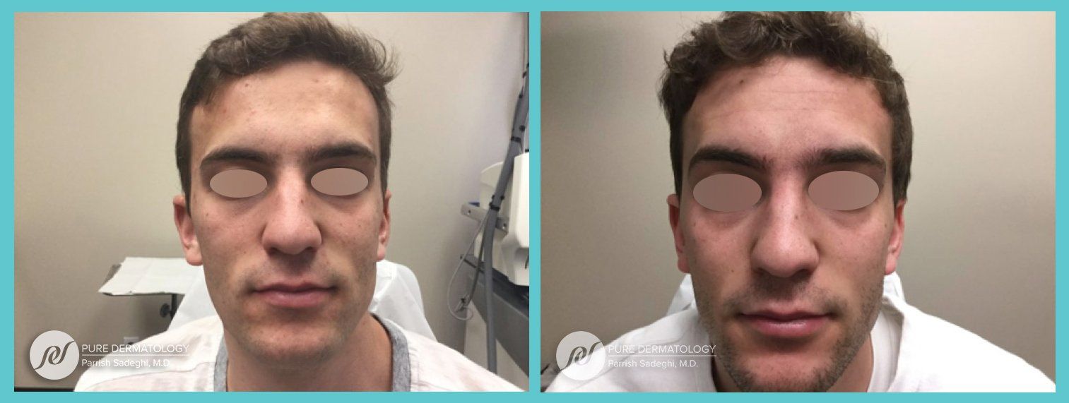 Two pictures of a man 's face before and after surgery.