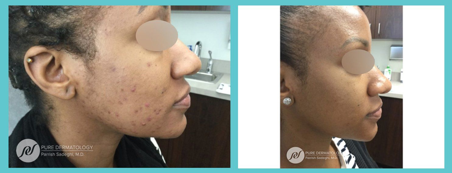 patient before and after Acne treatment at Pure Dermatology