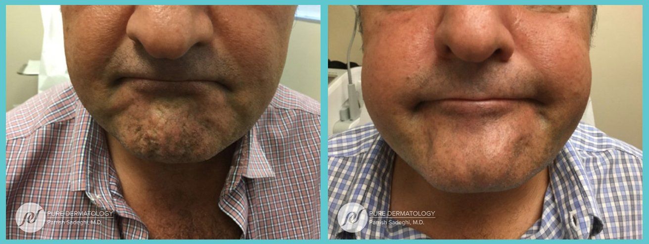 patient before and after Botox injections at Pure Dermatology