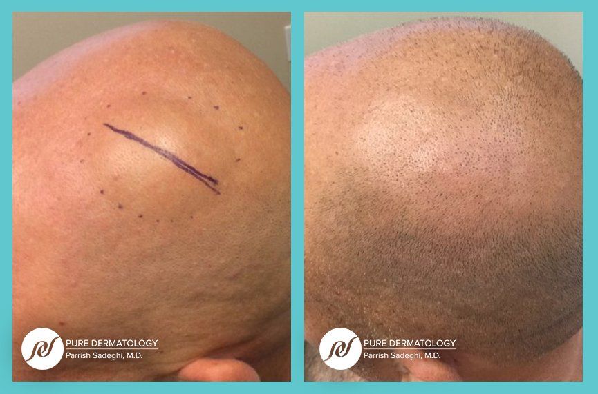 patient before and after Lipoma Removal treatment at Pure Dermatology