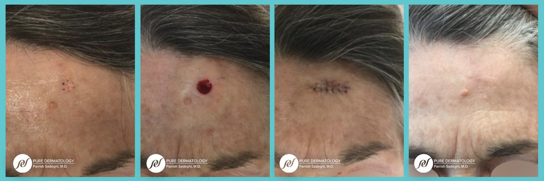 patient before and after Mohs Micrographic Surgery at Pure Dermatology