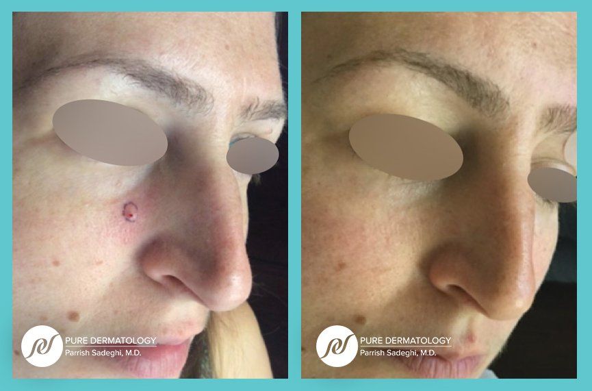 A before and after photo of a woman 's face with a wart on her nose.