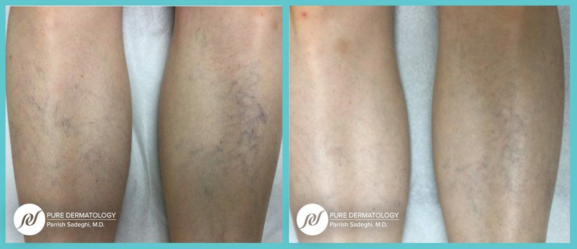 A before and after photo of a person 's legs with varicose veins