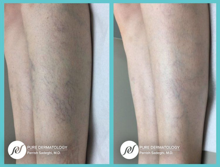 A before and after photo of a person 's legs