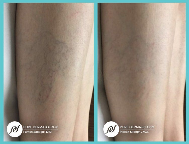 patient before and after Spider Vein treatment at Pure Dermatology