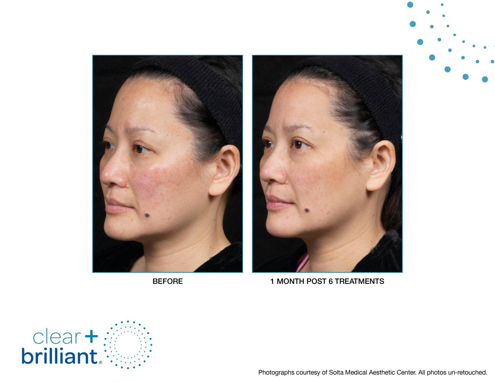 before and after Fraxel laser treatment side profile