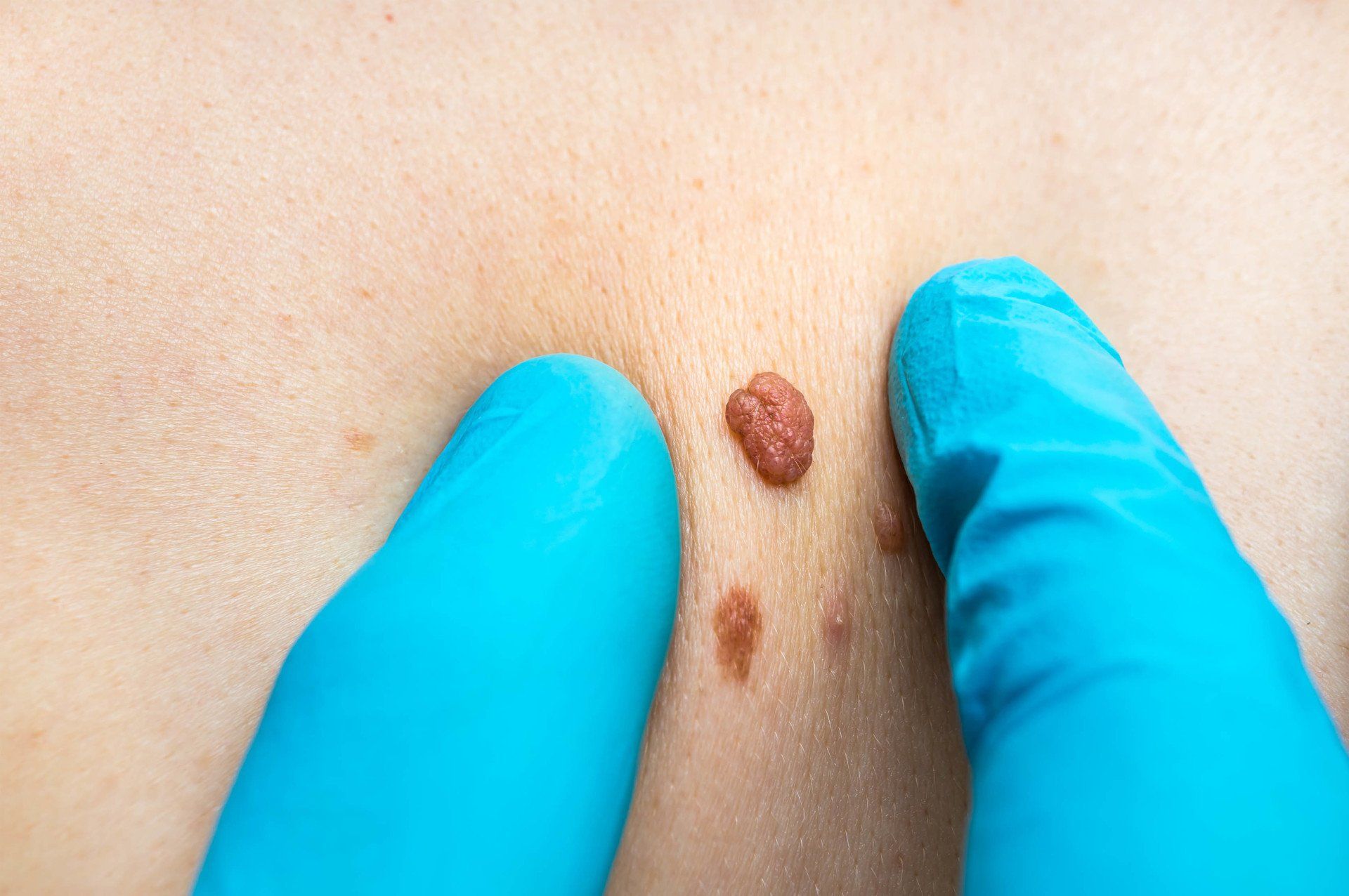 doctor examining skin tag mole