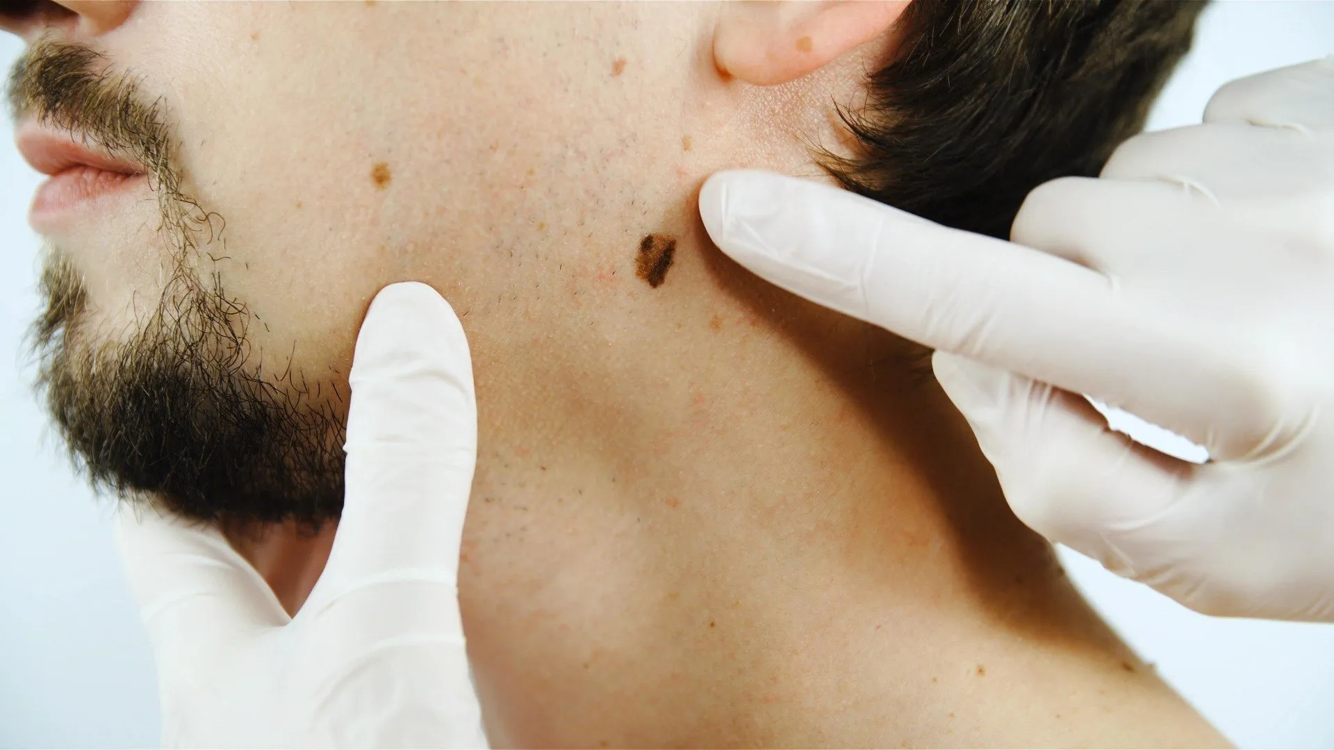 doctor inspecting mole on man's jawline