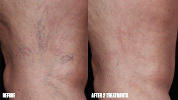 before and after scar treatment with Excel V laser