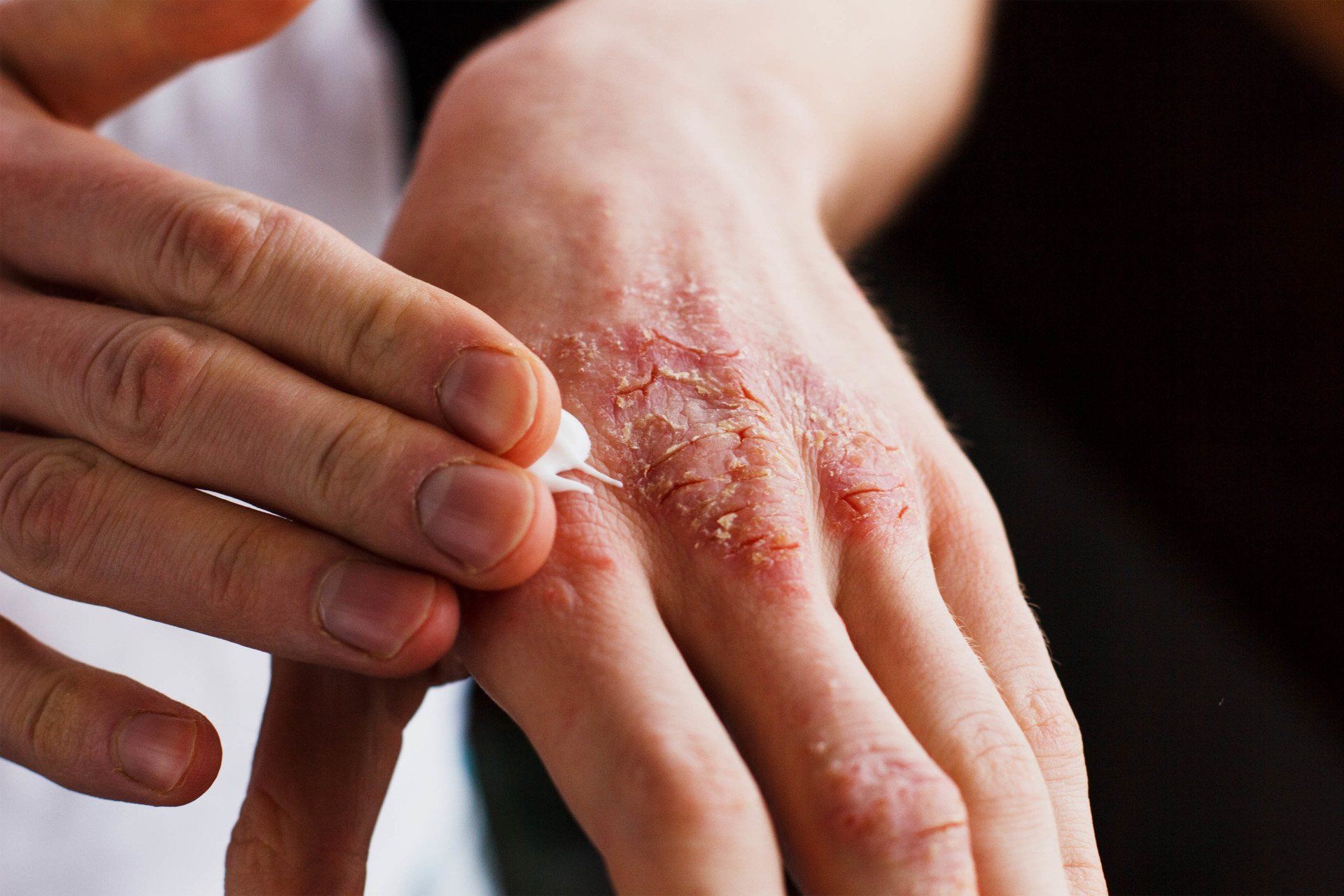 man-applying-cream-eczema-hand