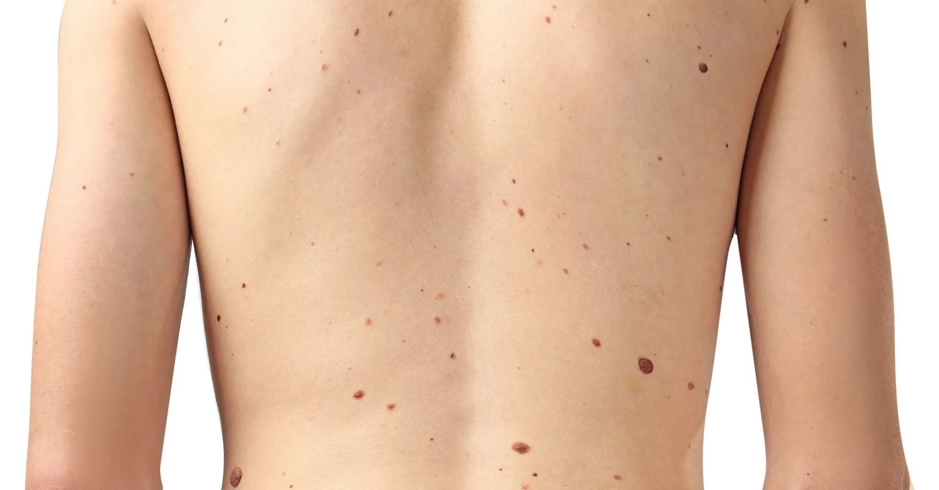 man's back covered in moles
