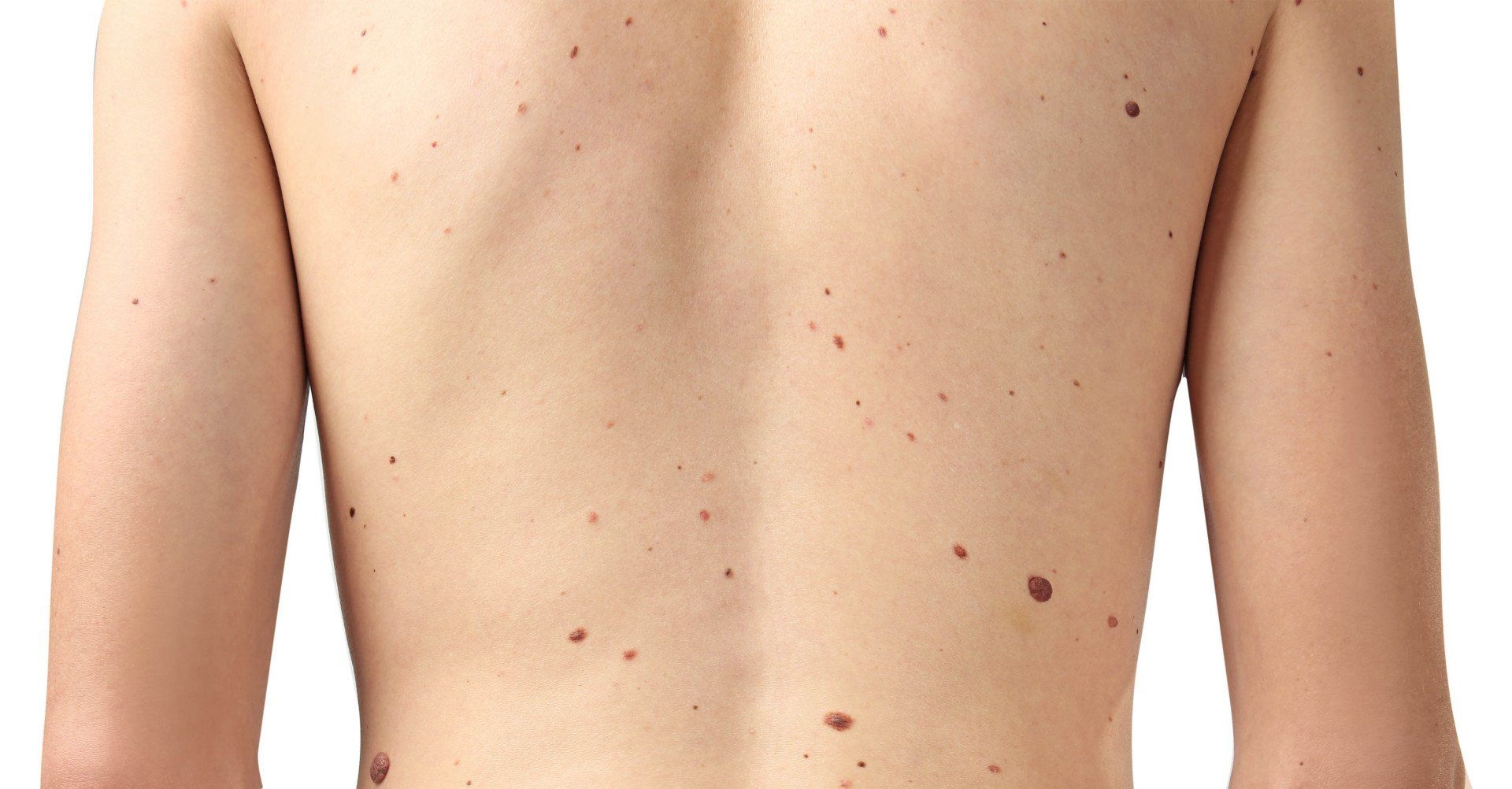 moles on the back of a young man
