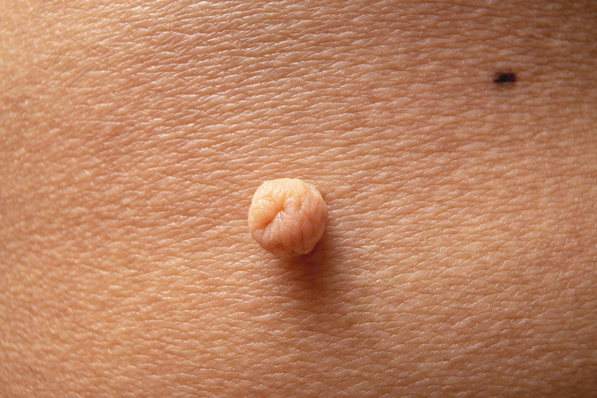 close up of skin tag mole