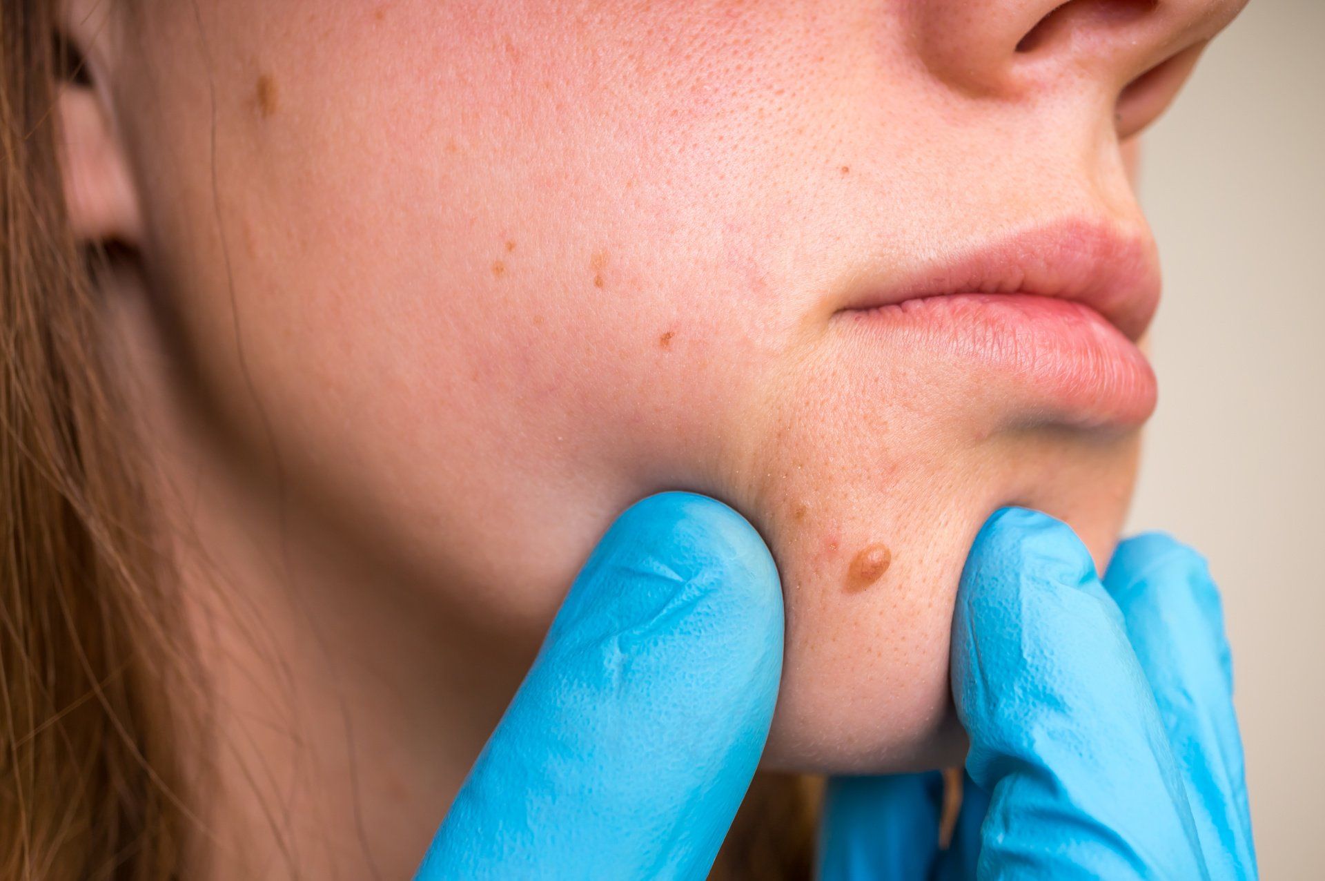 woman with skin tag on chin