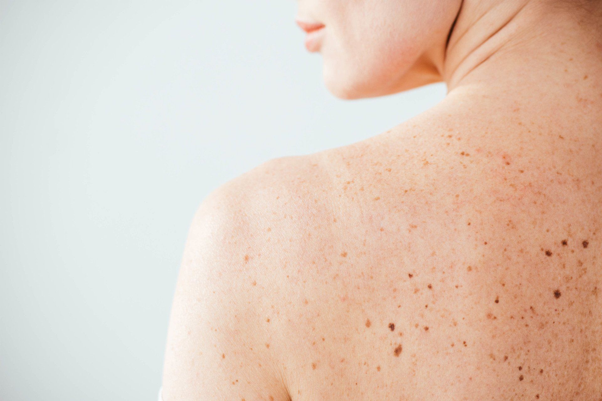 moles and skin tags need surgical treatment at Pure Dermatology