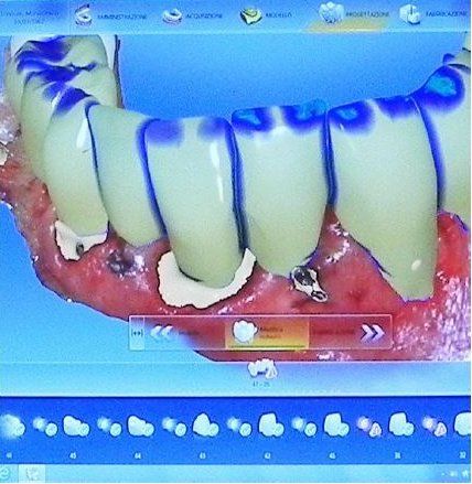 implantologia computer-guidata