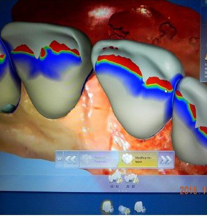 implantologia computer-guidata a carico immediato