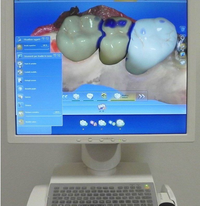 implantologia a carico immediato computer-guidata