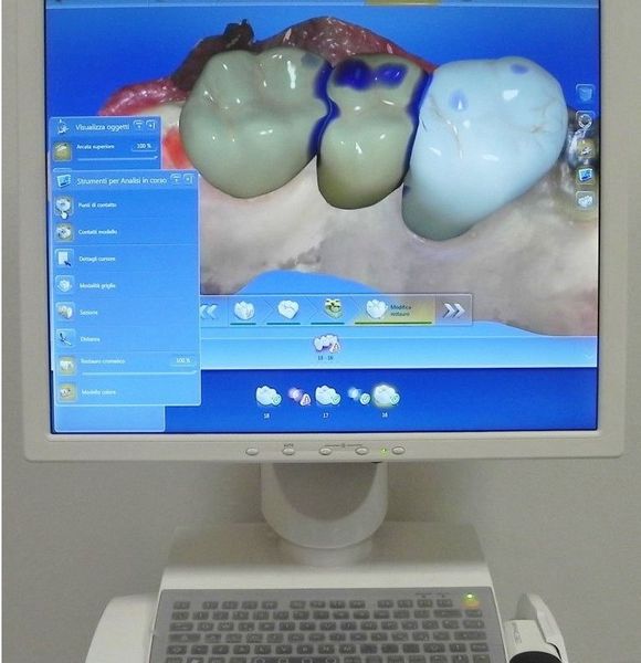 implantologia a carico immediato computer-guidata