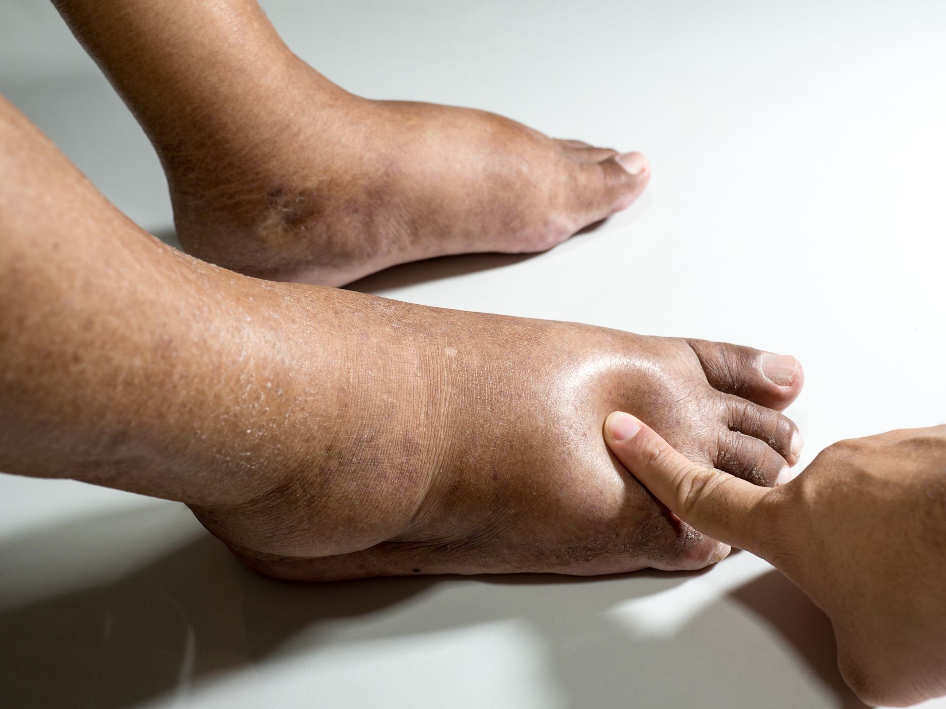 Swollen foot with finger pressing into the skin, showing edema.