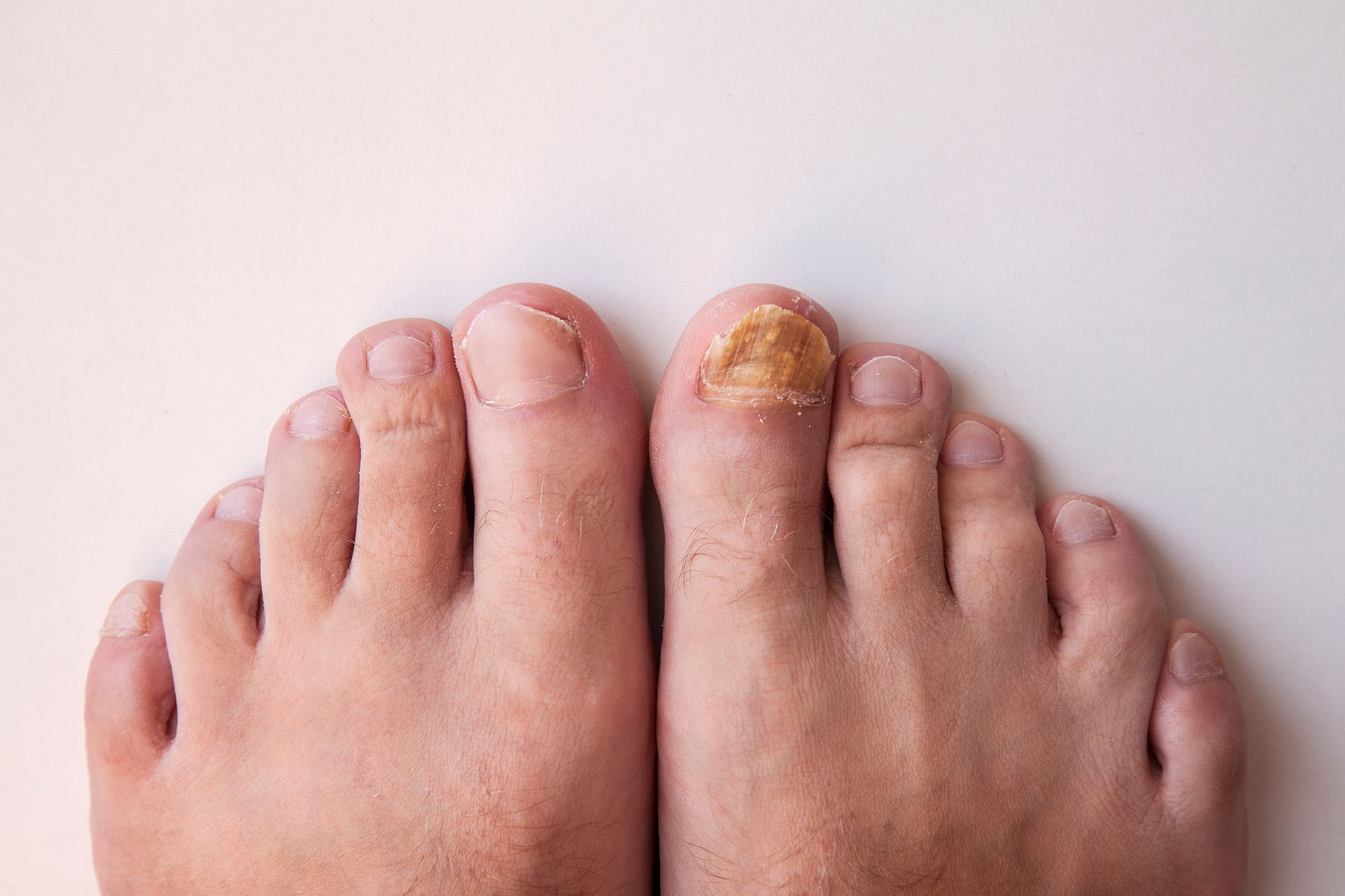 Two feet with one toenail showing fungal infection; yellow and thick.