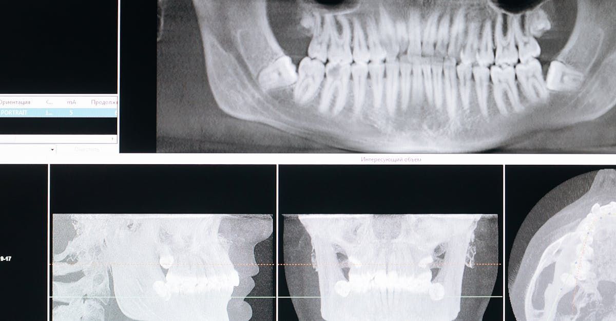 A black and white x-ray of a person 's skull and teeth