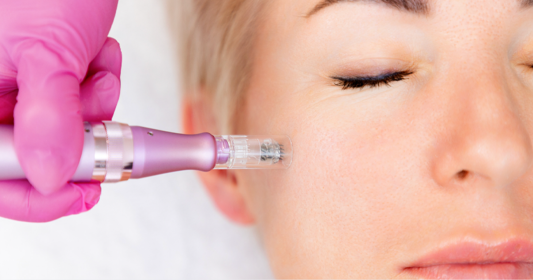 Microneedling