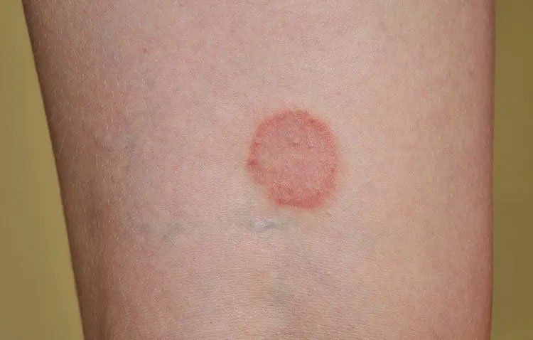 Tinea Corporis (Ringworm) - Online Dermatology