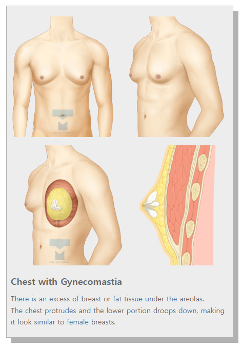 Custom breast surgery at TRUEMAN Medical Center with continuous research, competitive medical staff, and expert gynecomastia treatment by Chief Director Dr. Yang Ki-hoon.
