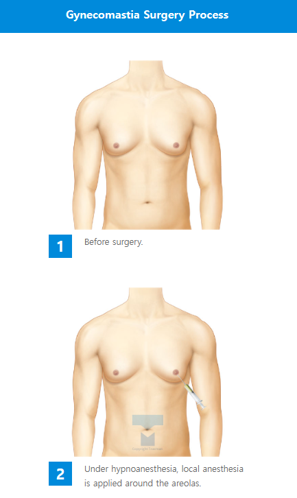 Custom breast surgery at TRUEMAN Medical Center with continuous research, competitive medical staff, and expert gynecomastia treatment by Chief Director Dr. Yang Ki-hoon.