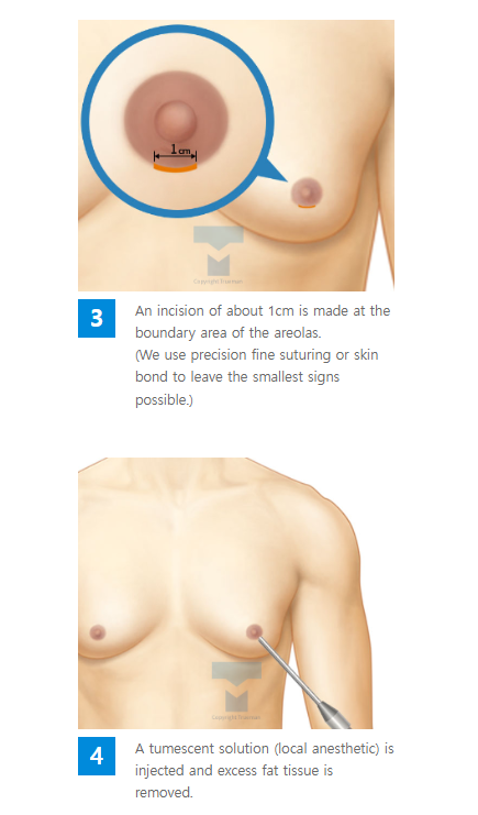 Custom breast surgery at TRUEMAN Medical Center with continuous research, competitive medical staff, and expert gynecomastia treatment by Chief Director Dr. Yang Ki-hoon.