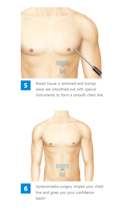 Custom breast surgery at TRUEMAN Medical Center with continuous research, competitive medical staff, and expert gynecomastia treatment by Chief Director Dr. Yang Ki-hoon.