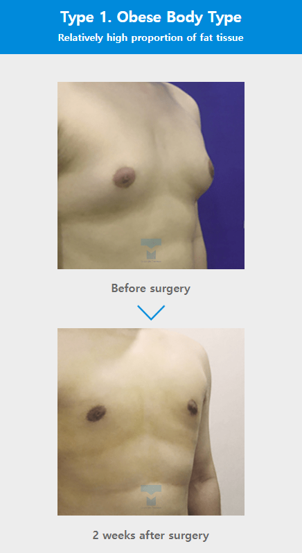 Custom breast surgery at TRUEMAN Medical Center with continuous research, competitive medical staff, and expert gynecomastia treatment by Chief Director Dr. Yang Ki-hoon.