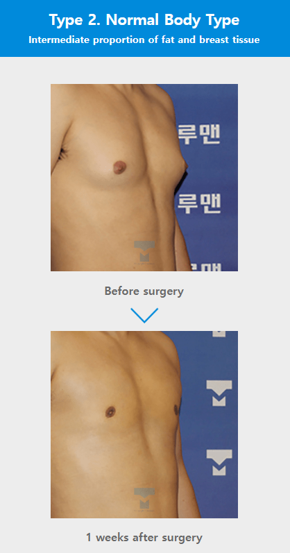 Custom breast surgery at TRUEMAN Medical Center with continuous research, competitive medical staff, and expert gynecomastia treatment by Chief Director Dr. Yang Ki-hoon.