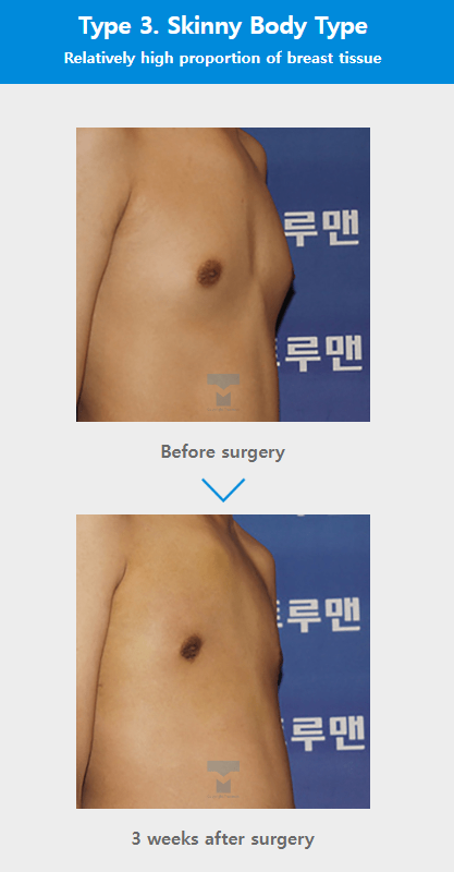 Custom breast surgery at TRUEMAN Medical Center with continuous research, competitive medical staff, and expert gynecomastia treatment by Chief Director Dr. Yang Ki-hoon.