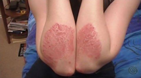 dermatite su avambraccio