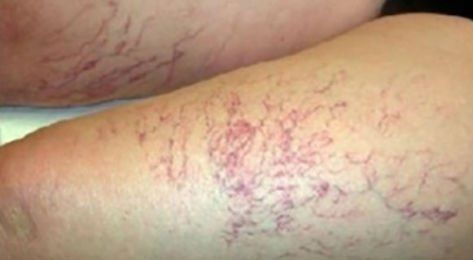 gambe con capillari in evidenza