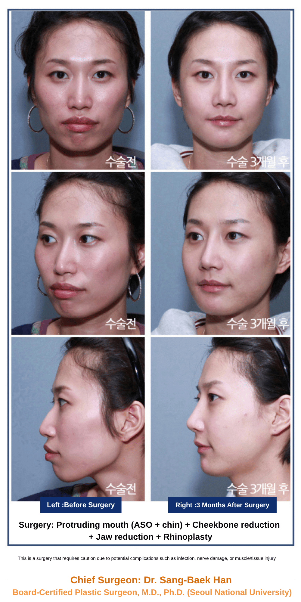 VXil Lifting + Double Chin Liposuction